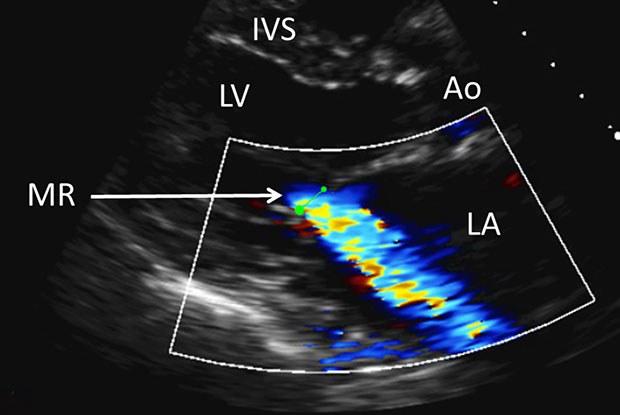 Mitral Kapak Yetersizliği — bilgilendirme görseli