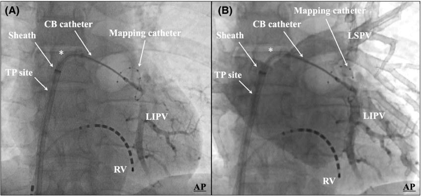 Atrial Fibrillation Ablation procedure