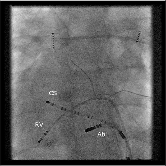 Electrophysiological Study (EPS) procedure