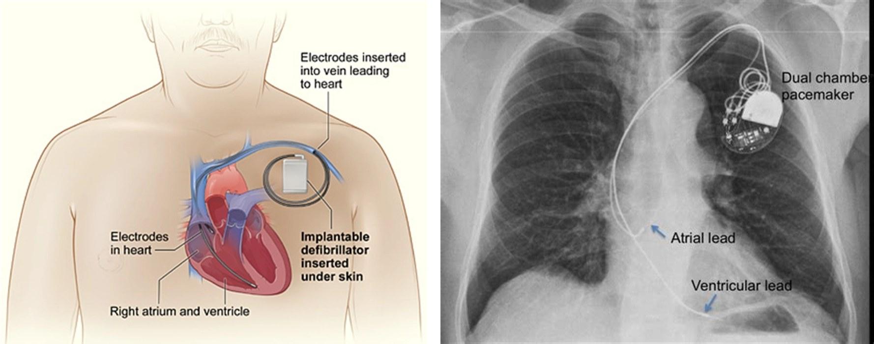 Pacemaker procedure