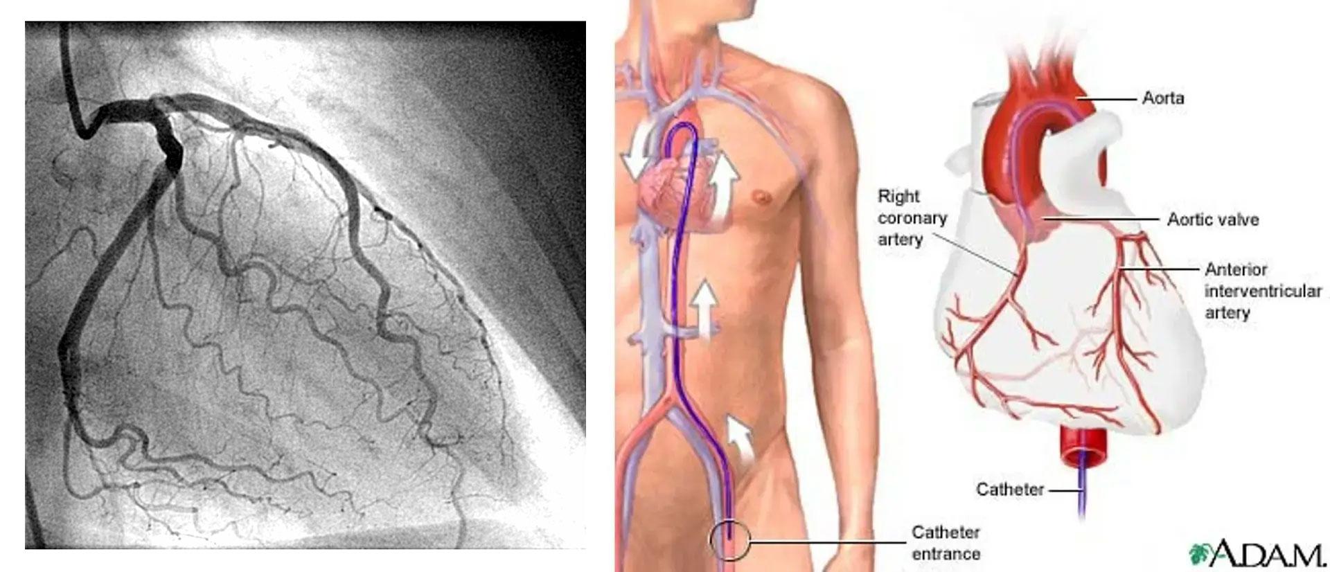 Coronary Angiography procedure