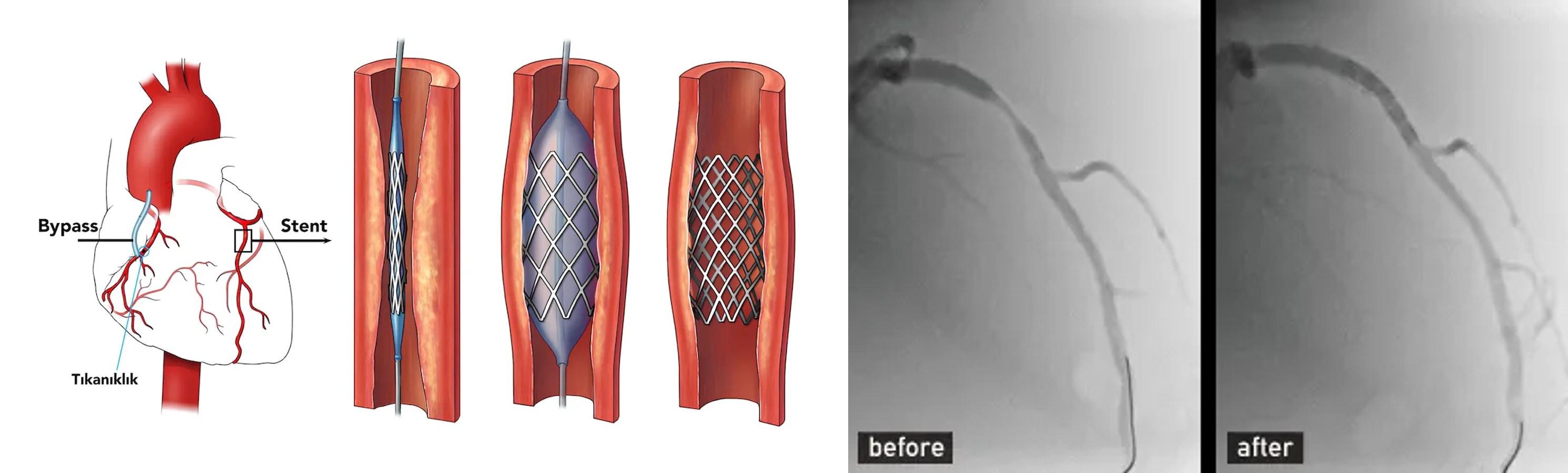 Coronary Stenting procedure