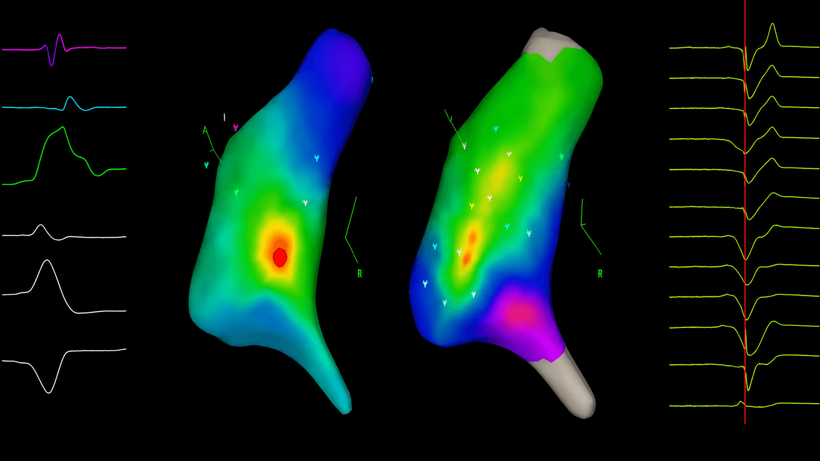 PVC / VES Ablation