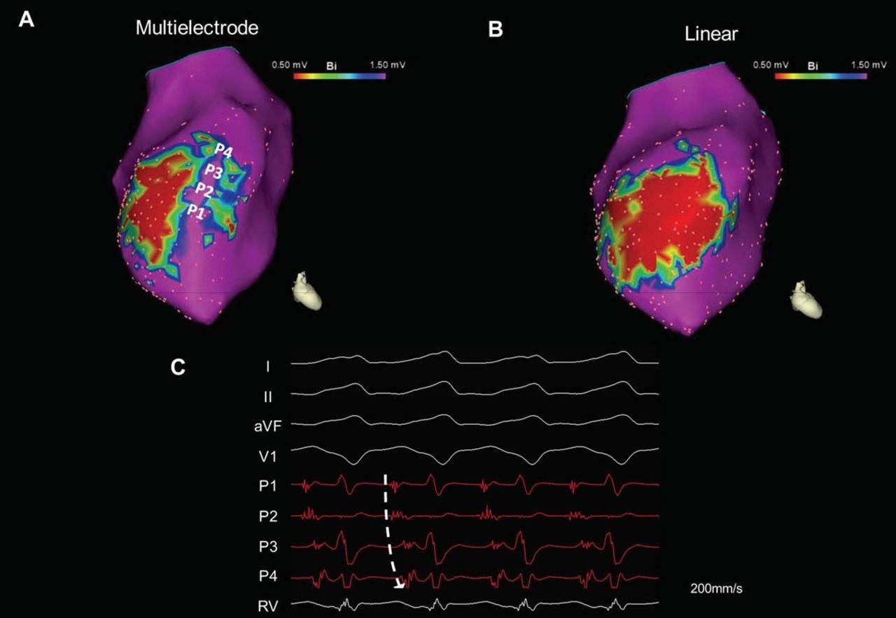 VT Ablation