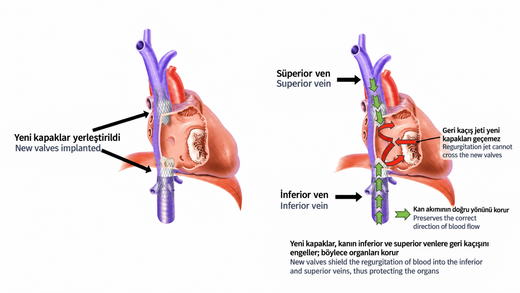 TricValve